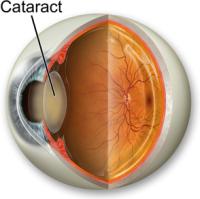 Ayurveda for cataract