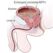prostrated Enlargement