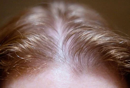Learn The Reasons Why You Are Losing Hair - Ayurveda Blog
